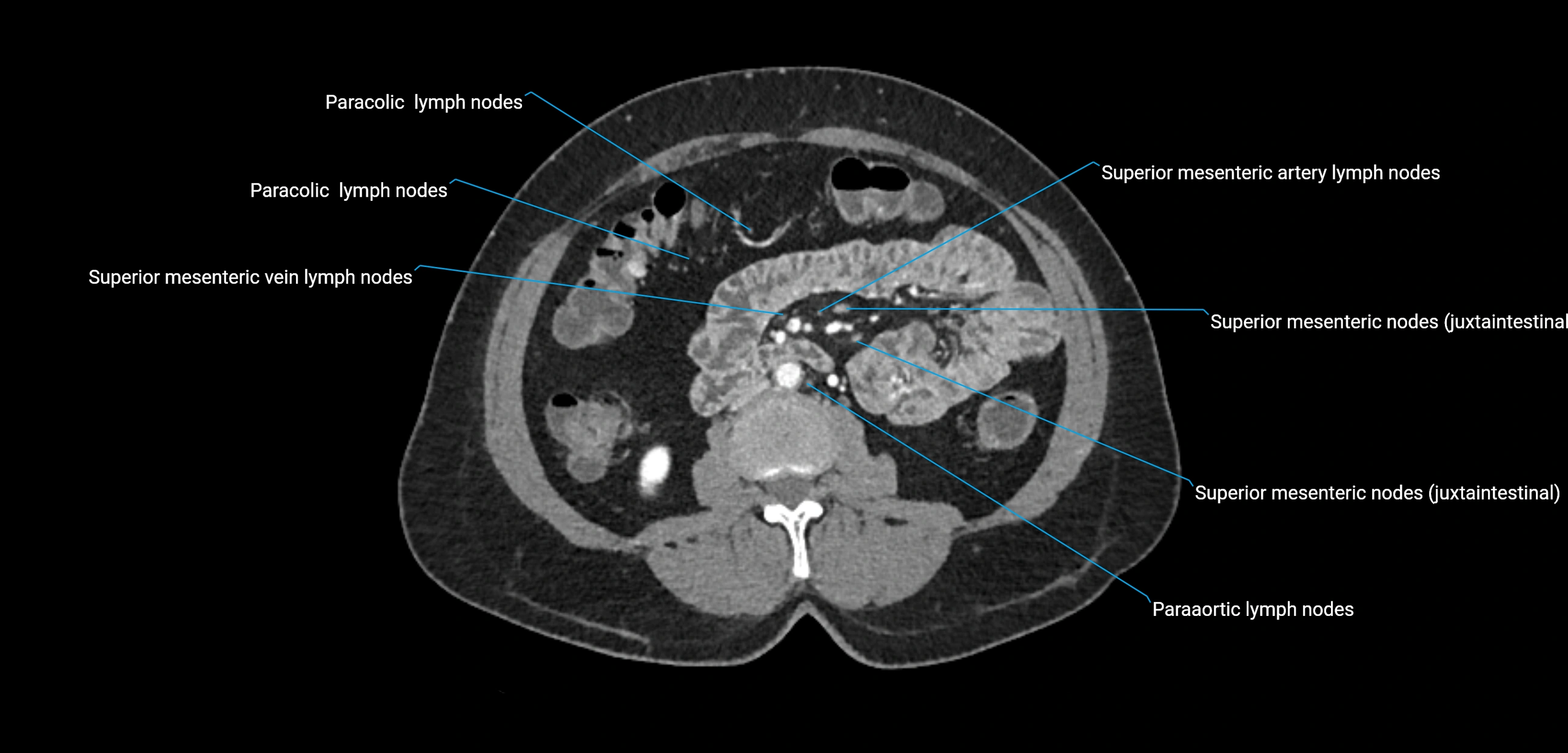 CT ct abdominal lymph nodes  axial cross sectional anatomy  enchanced radiology image -img-00002-00219.webp